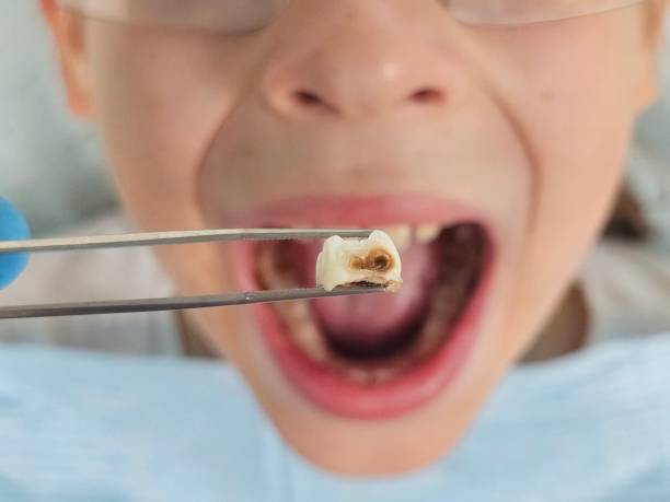 Best Emergency Tooth Extraction in West St Paul, MN